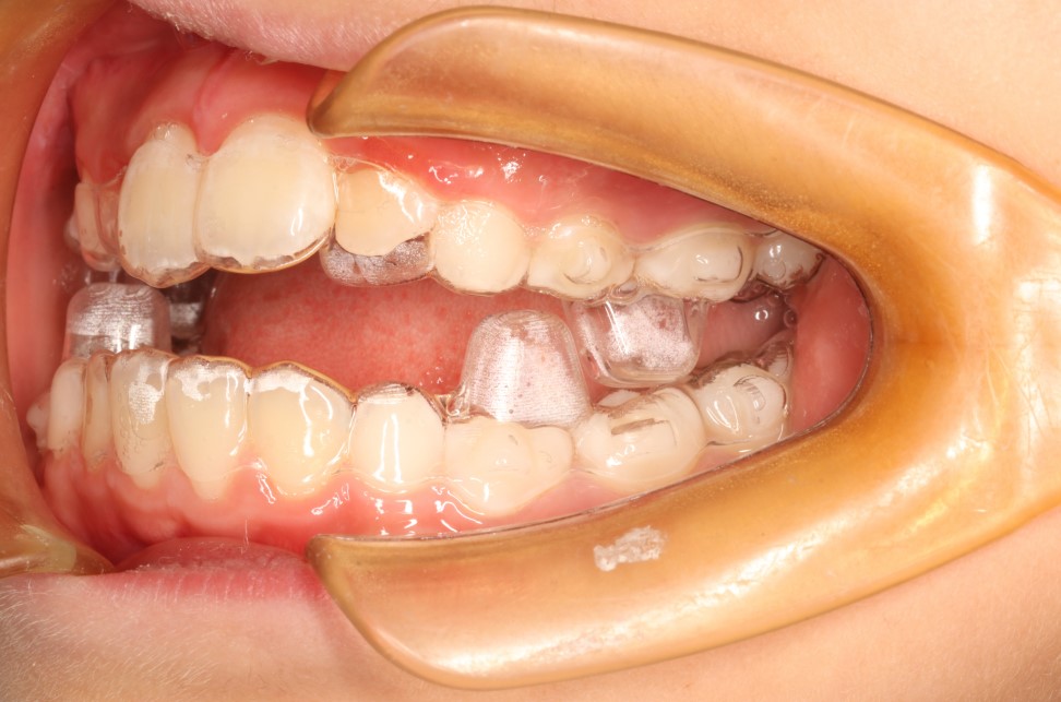  我们为何专注于儿童早期矫治？ 